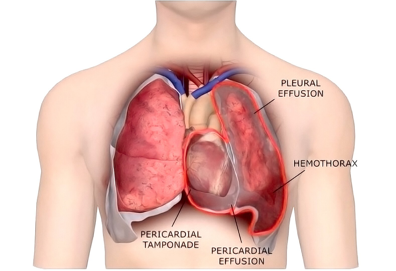 Pleural Disease