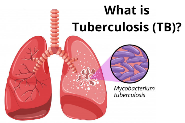 Tuberculosis (TB)